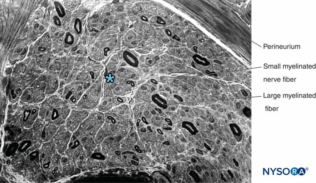 Semithin section of human sural nerve stained by cresyl violet. Axonal neuropathy with the predominant loss of large myelinated fibers. * Intrafascicular space between myelinated fibers (occupied by endoneurium, Schwann cell nuclei, and unmyelinated fibers).