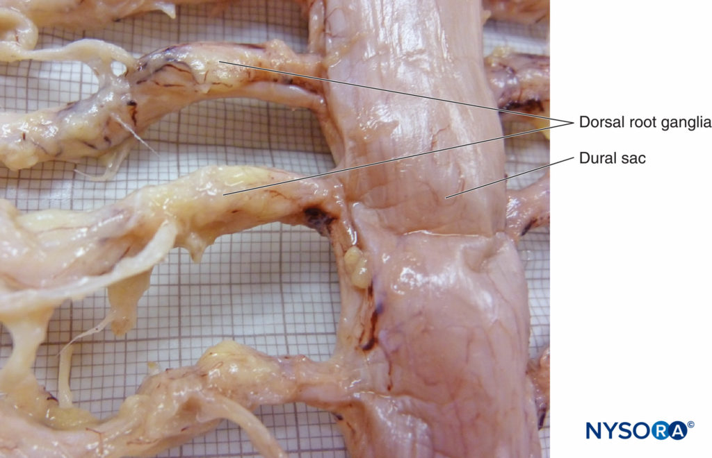 Human dural sac. (Reproduced with permission from Reina MA, López García A, de Andrés JA, et al: Thickness variation of the dural sac. Rev Esp Anestesiol Reanim. 1999 Oct;46(8):344-349.)