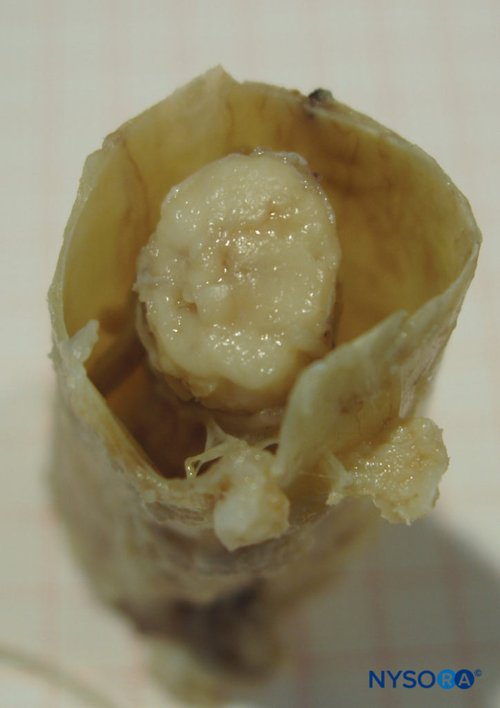 Human dural sac and end spinal cord. (Reproduced with permission from Reina MA, Pulido P, López A. El saco dural humano: Rev Arg Anestesiol. 2007; 65:167-184.)
