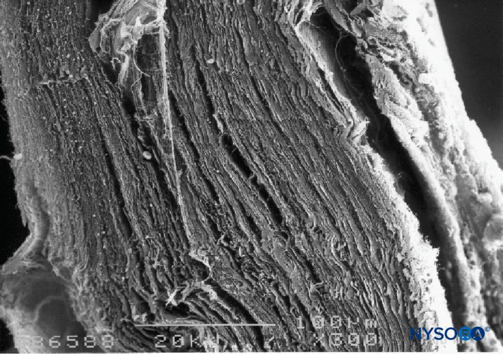 Thickness of the dural sac. Scanning electron microscopy. Magnification ×300. (Reproduced with permission from Reina MA, Dittmann M, López A, et al: New perspectives in the microscopic structure of human dura mater in the dorso lumbar region. Reg Anesth. 1997 Mar-Apr;22(2):161-166.)