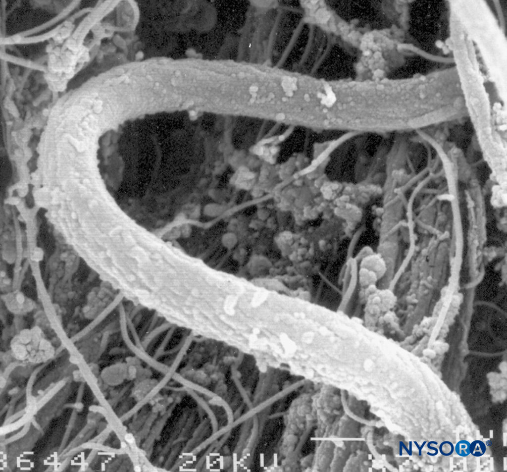 Elastic fibers of the dural sac. Scanning electron microscopy. Magnification ×7000. (Reproduced with permission from Reina MA, López A, Dittmann M, et al: External and internal surface of human dura mater by scanning electron microscopy. Rev Esp Anestesiol Reanim. 1996 Apr;43(4):130-4.)