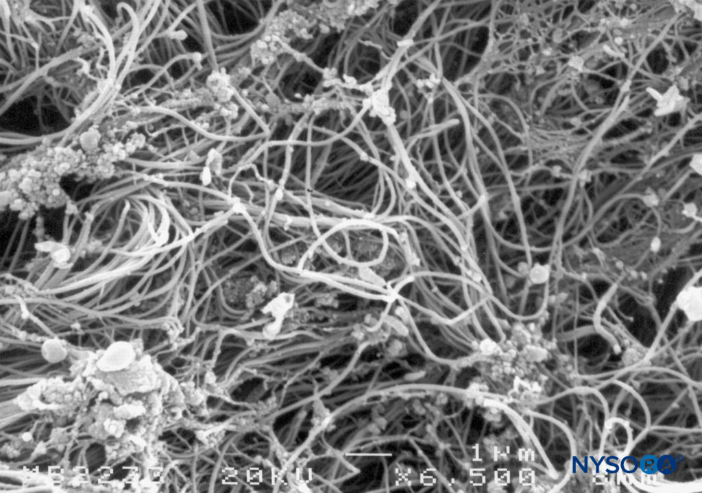 Detail of epidural surface of the dural sac. Scanning electron microscopy. Magnification ×6500. (Reproduced with permission from Dittmann M, Reina MA, López A: Neue ergebnisse bei der darstellung der dura mater spinalis mittles rasterelektronenmikroskopie. Anaesthesist. 1998 May;47(5):409-413.)