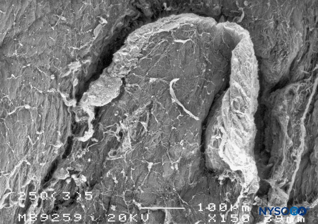 Dura-arachnoid lesion produced with 25-G Quincke needle. Epidural surface. Scanning electron microscopy. Magnification ×150. (Reproduced with permission from Reina MA, Castedo J, López A. Cefalea pospunción dural: Ultraestructura de las lesiones durales y agujas espinales usadas en las punciones lumbares. Rev Arg Anestesiol. 2008 Jan-Mar 66(1):6-26.)