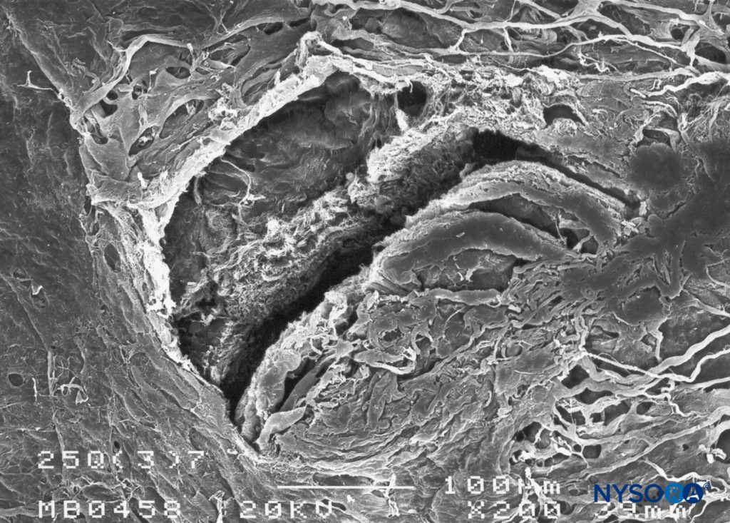 Dura-arachnoid lesion produced with 25-G Quincke needle. Arachnoid surface. Scanning electron microscopy. Magnification ×200. (Reproduced with permission from Reina MA, Castedo J, López A. Cefalea pospunción dural: Ultraestructura de las lesiones durales y agujas espinales usadas en las punciones lumbares. Rev Arg Anestesiol. 2008 Jan-Mar 66(1):6-26.)