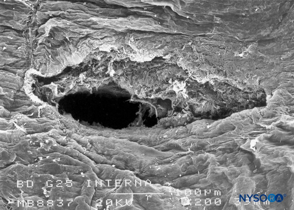 Dura-arachnoid lesion produced with 25-G Whitacre needle. Arachnoid surface. Scanning electron microscopy. Magnification ×200. (Reproduced with permission from Reina MA, López-García A, de Andrés-Ibáñez JA, et al: Electron microscopy of the lesions produced in the human dura mater by Quincke beveled and Whitacre needles. Rev Esp Anestesiol Reanim. 1997 Feb;44(2):56-61.)