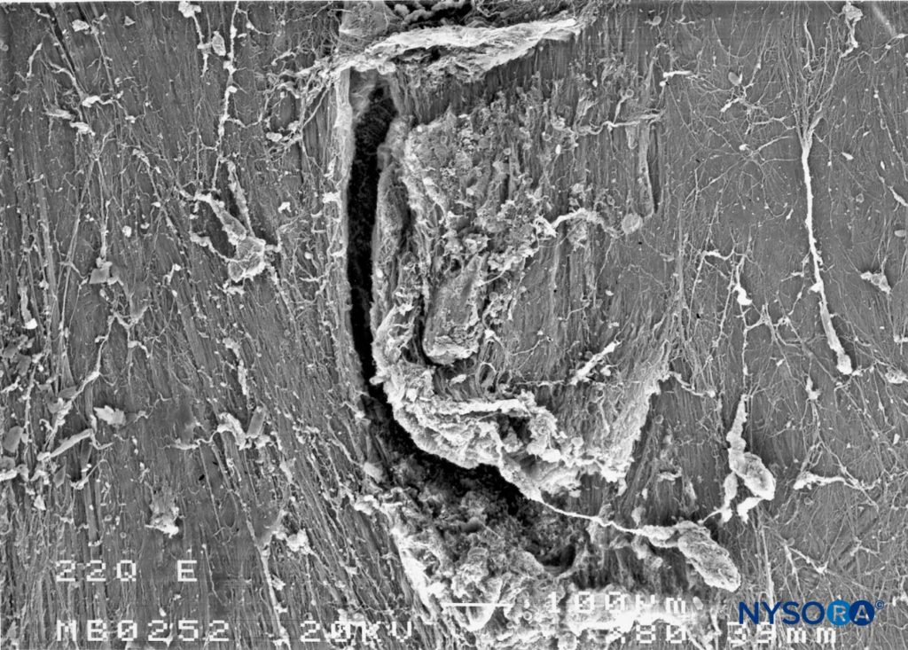 Dura-arachnoid lesion produced with 22-G Quincke needle. Epidural surface. Scanning electron microscopy. Magnification ×80. (Reproduced with permission from Reina MA, Castedo J, López A. Cefalea pospunción dural: Ultraestructura de las lesiones durales y agujas espinales usadas en las punciones lumbares. Rev Arg Anestesiol. 2008 Jan-Mar 66(1):6-26.)