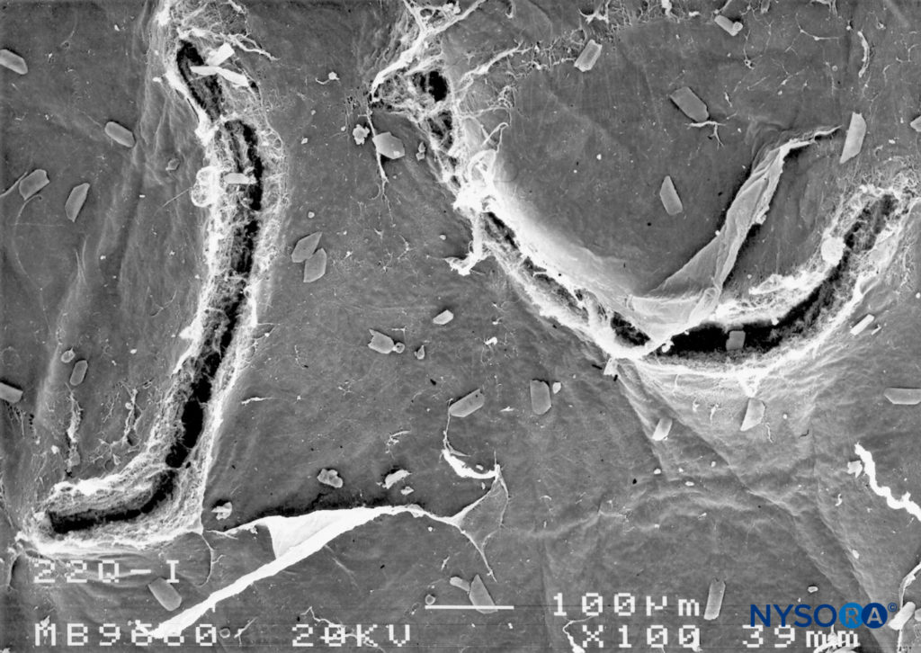 Dura-arachnoid lesion produced with 22-G Quincke needle. Arachnoid surface. Scanning electron microscopy. Magnification ×100. (Reproduced with permission from Raj P: Textbook of Regional Anesthesia. Philadelphia: Churchill Livingstone; 2002.)