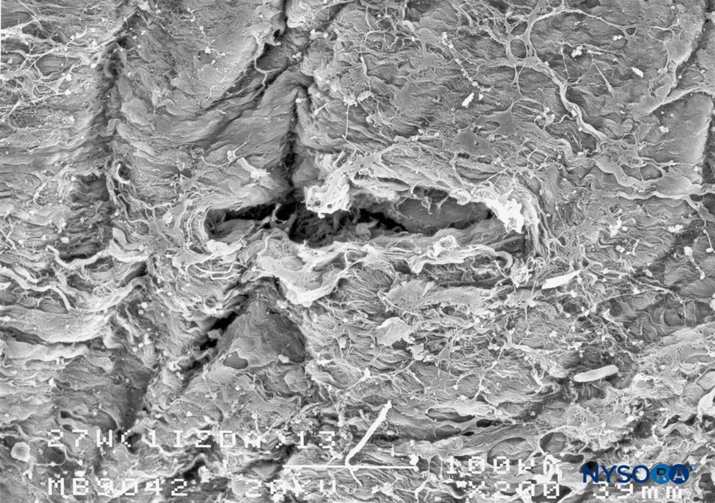Dura-arachnoid lesion produced with 27-G Whitacre needle. Epidural surface. Scanning electron microscopy. Magnification ×200. (Reproduced with permission from Reina MA, Castedo J, López A. Cefalea pospunción dural: Ultraestructura de las lesiones durales y agujas espinales usadas en las punciones lumbares. Rev Arg Anestesiol. 2008 Jan-Mar 66(1):6-26.)