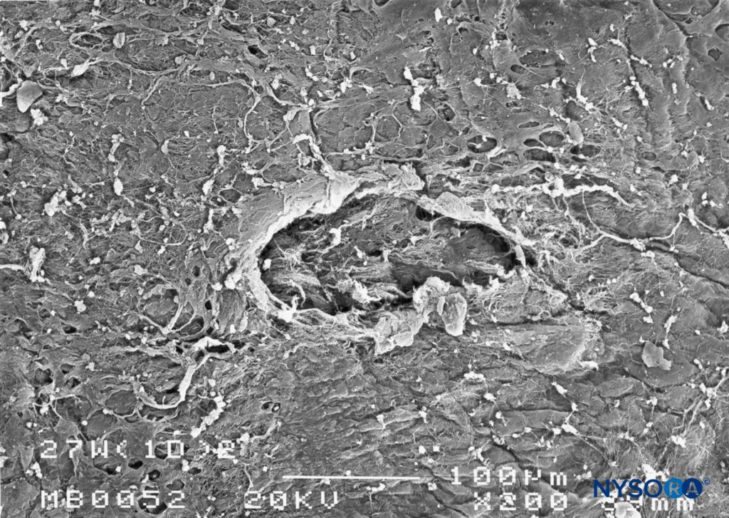 Dura-arachnoid lesion produced with 27-G Whitacre needle. Epidural surface. Scanning electron microscopy. Magnification ×200. (Reproduced with permission from Reina MA, Castedo J, López A. Cefalea pospunción dural: Ultraestructura de las lesiones durales y agujas espinales usadas en las punciones lumbares. Rev Arg Anestesiol. 2008 Jan-Mar 66(1):6-26.)