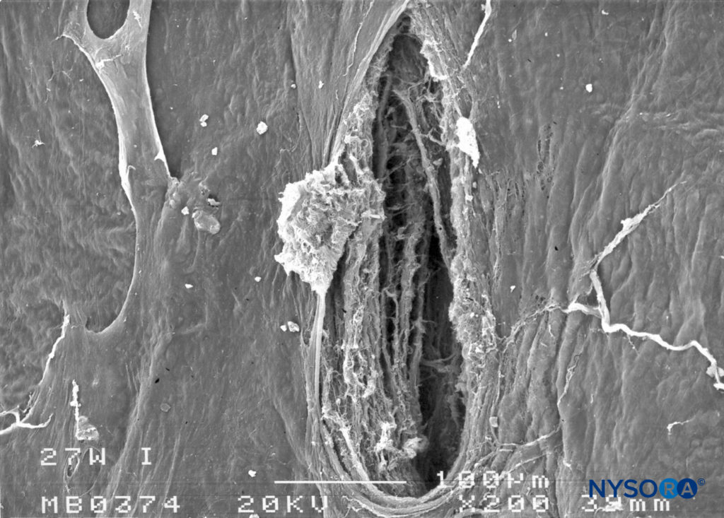 Dura-arachnoid lesion produced with 27-G Whitacre needle. Arachnoid surface. Scanning electron microscopy. Magnification ×200. (Reproduced with permission from Reina MA, Castedo J, López A. Cefalea pospunción dural: Ultraestructura de las lesiones durales y agujas espinales usadas en las punciones lumbares. Rev Arg Anestesiol. 2008 Jan-Mar 66(1):6-26.)