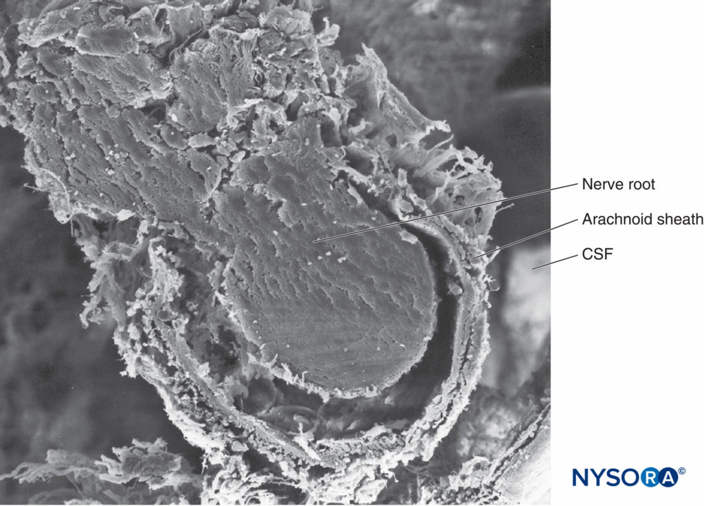 Trabecular arachnoid layer. The projections of trabecular arachnoid that cover nerve roots are called arachnoid sheaths. CSF = cerebrospinal fluid. Scanning electron microscopy. Magnification ×100. (Reproduced with permission from Reina MA, López A, De Andrés JA: Hypothesis concerning the anatomical basis of cauda equina syndrome and transient nerve root irritation after spinal anesthesia. Rev Esp Anestesiol Reanim. 1999 Mar;46(3):99-105.)