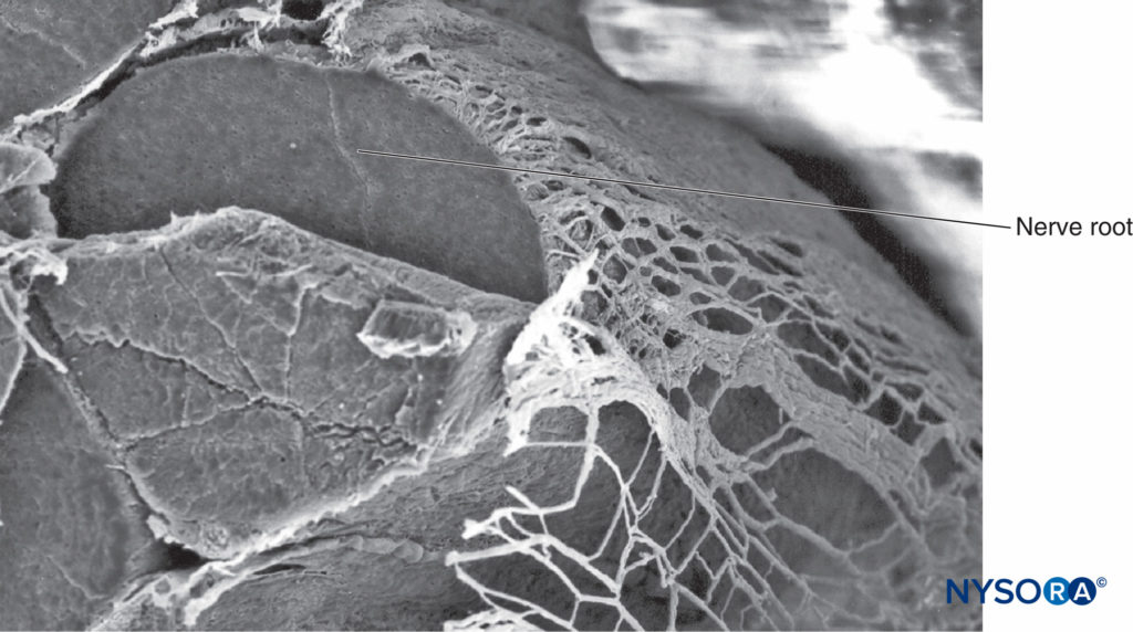 Nerve root and arachnoid sheath. Scanning electron microscopy. Magnification ×80. (Reproduced with permission from Reina MA, Villanueva MC, López A: Aracnoides trabecular, piamadre espinal humana y anestesia subaracnoidea, Rev Arg Anestesiol 2008;66: 111–133.)