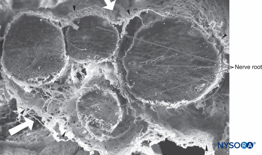 Four-nerve root and its arachnoid sheaths. Scanning electron microscopy. Magnification ×100. (Reproduced with permission from Reina MA, López A, De Andrés JA: Hypothesis concerning the anatomical basis of cauda equina syndrome and transient nerve root irritation after spinal anesthesia. Rev Esp Anestesiol Reanim. 1999 Mar;46(3):99-105.)
