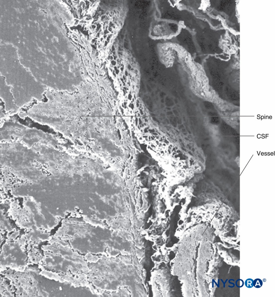 Human spinal cord and trabecular arachnoid layer. CSF = cerebrospinal fluid. Scanning electron microscopy. Magnification ×40. (Reproduced with permission from Reina MA, Machés F, López A, et al: The ultrastructure of the spinal arachnoid in humans and its impact on spinal anesthesia, cauda equina syndrome, and transient neurological syndrome. Tech Reg Anesth Pain Management. 2008 July;12(3):153-160.)