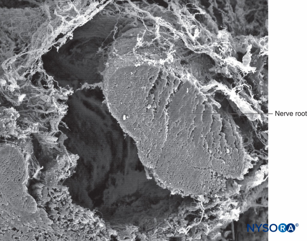 Nerve root and arachnoid sheath. Scanning electron microscopy. Magnification ×100. (Reproduced with permission from Torres LM: Textbook of Anesthesia and Pain Management. Aran Ed; 2001.)