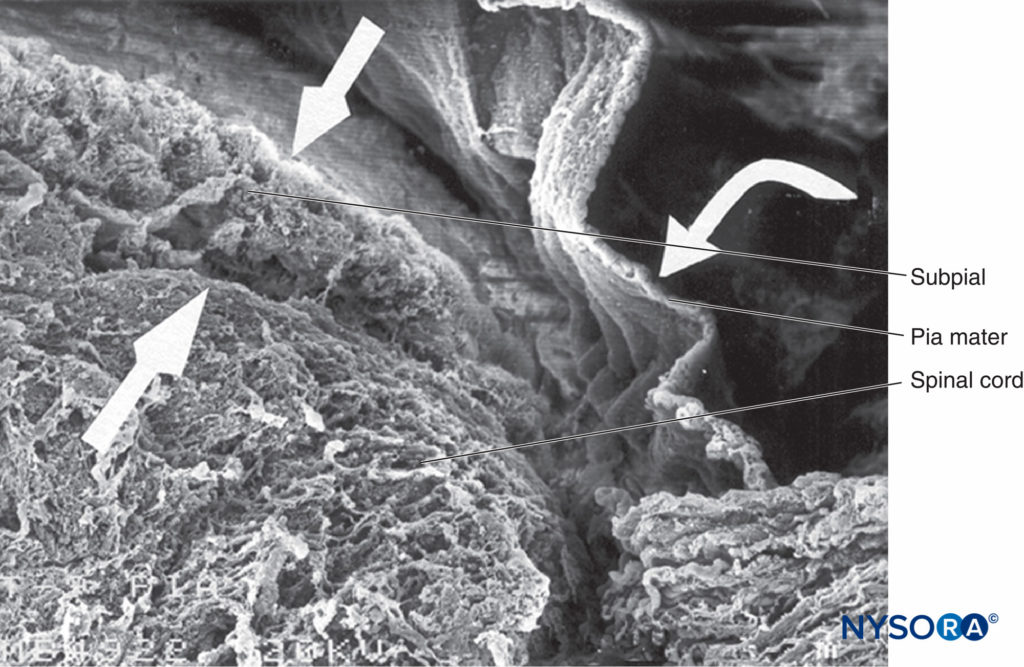 Human pia mater and spinal cord. Scanning electron microscopy. Magnification ×70. (Reproduced with permission from Reina MA, De Leon Casasola O, et al: Ultrastructural findings in human spinal pia mater in relation to subarachnoid anesthesia. Anesth Analg. 2004 May;98(5):1479-1485.)