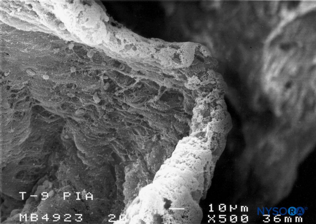 Detail of pia mater. Scanning electron microscopy. Magnification ×500. (Reproduced with permission from Reina MA, Wikinski J, De Andrés JA: Una rara complicación de la anestesia epidural y subaracnoidea. Tumores epidermoideos espinales iatrogénicos. Rev Arg Anestesiol. 2008;66:319-336.)