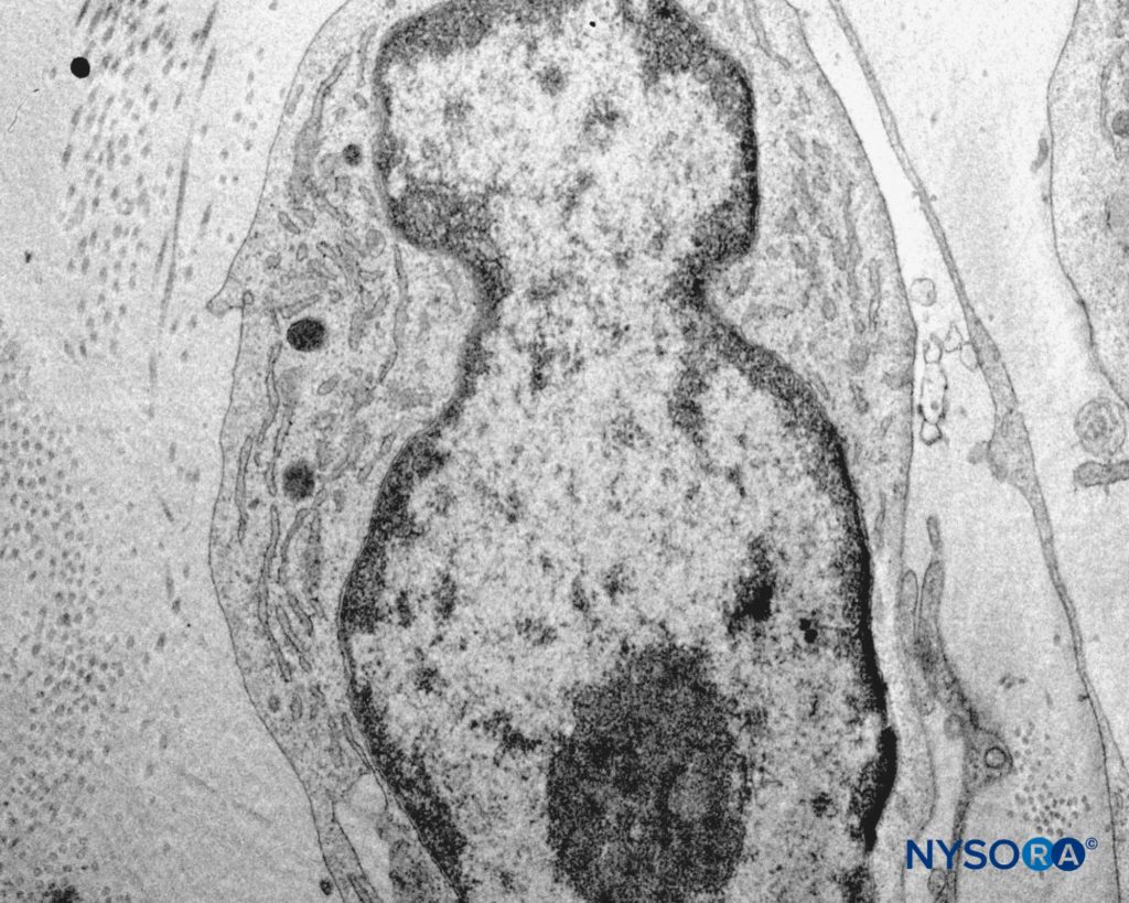 Detail of pial cells. Transmission electron microscopy. Magnification ×12,000. (Reproduced with permission from Reina MA, Wikinski J, De Andrés JA: Una rara complicación de la anestesia epidural y subaracnoidea. Tumores epidermoideos espinales iatrogénicos. Rev Arg Anestesiol. 2008;66:319-336.)