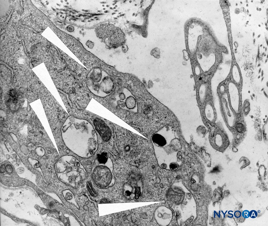 Detail of macrophagic cells in spinal pia mater. Transmission electron microscopy. Magnification ×12,000. (Reproduced with permission from Reina MA, Wikinski J, De Andrés JA: Una rara complicación de la anestesia epidural y subaracnoidea. Tumores epidermoideos espinales iatrogénicos. Rev Arg Anestesiol. 2008;66:319-336.)