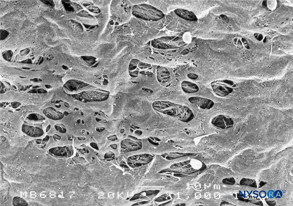 Fenestrations in human pia mater of conus medullaris. Scanning electron microscopy. Magnification ×1000. (Reproduced with permission from Reina MA, López García A, de Andrés JA: Anatomical description of a natural perforation present in the human lumbar pia mater. Rev Esp Anestesiol Reanim. 1998;45:4-7.)