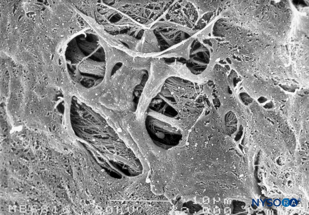 Fenestrations in human pia mater of conus medullaris. Scanning electron microscopy. Magnification ×2000. (Reproduced with permission from Reina MA, López García A, de Andrés JA: Anatomical description of a natural perforation present in the human lumbar pia mater. Rev Esp Anestesiol Reanim. 1998;45:4-7.)