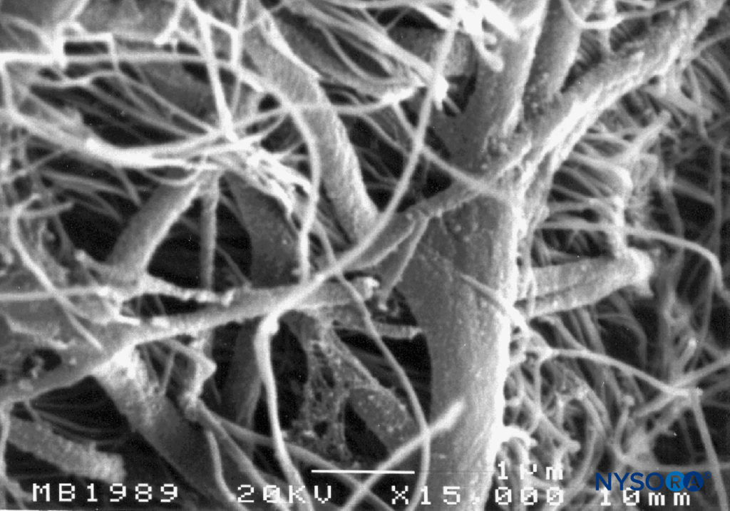 Neurothelial cells in the subdural compartment. Scanning electron microscopy. Magnification ×15,000. (Reproduced with permission from Reina MA, López A, De Andrés JA, Villanueva MC, Cortés L: Does the subdural space exist? Rev Esp Anestesiol Reanim. 1998 Nov;45(9):367-376.)