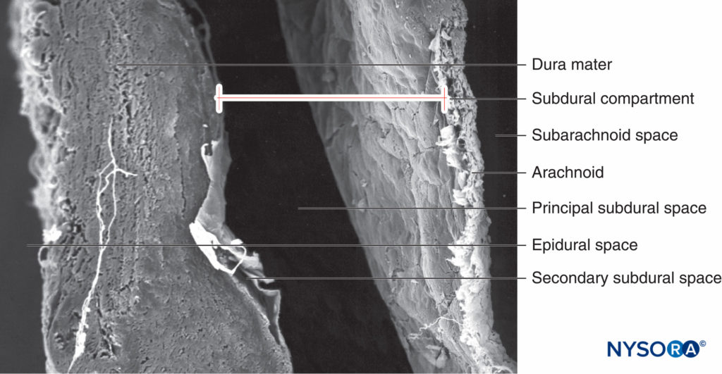Human subdural space in the lumbar meninges. Scanning electron microscopy. Magnification ×180. (Reproduced with permission from Reina MA, López A, De Andrés JA, Villanueva MC, Cortés L: Does the subdural space exist? Rev Esp Anestesiol Reanim. 1998 Nov;45(9):367-376.)