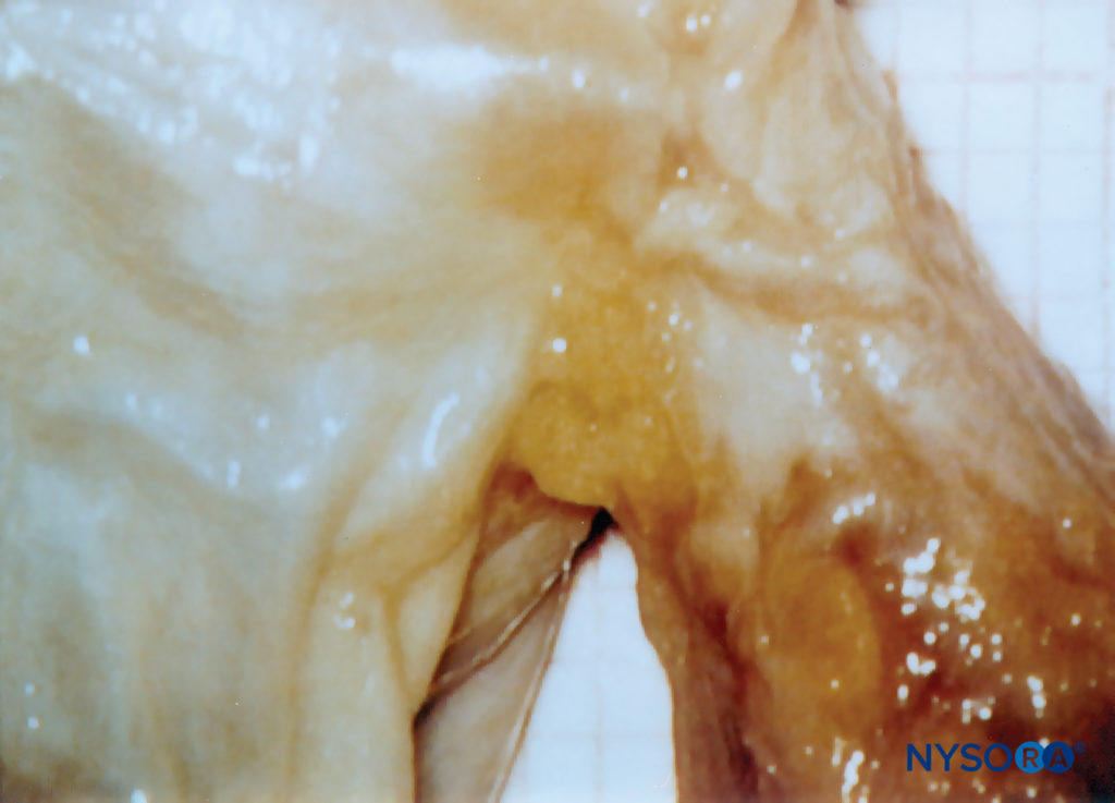Human nerve root cuff. (Reproduced with permission from Reina MA, Villanueva MC, López A, et al: Fat inside the dural sheath of lumbar nerve roots in humans. Rev Esp Anestesiol Reanim. 2007 May;54(5):297-301.)
