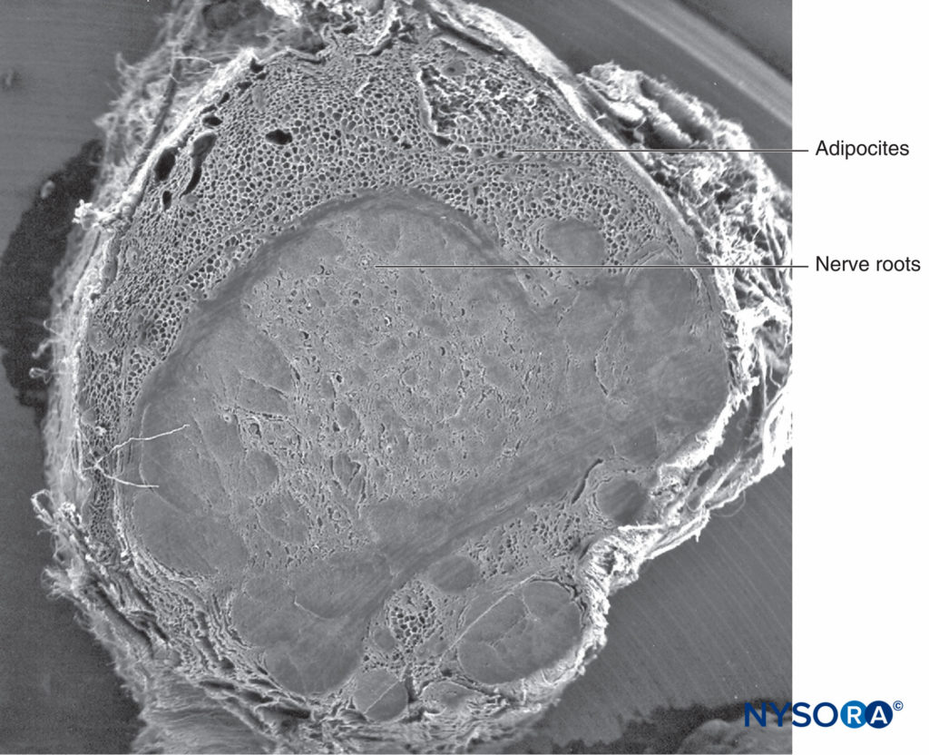 Human nerve root cuff. Scanning electron microscopy. Magnification ×12. (Reproduced with permission from Reina MA, Villanueva MC, Machés F, et al: Ultrastructure of human spinal nerve root cuff in lumbar spine. Anesth Analg. 2008 Jan;106(1): 339-344.)