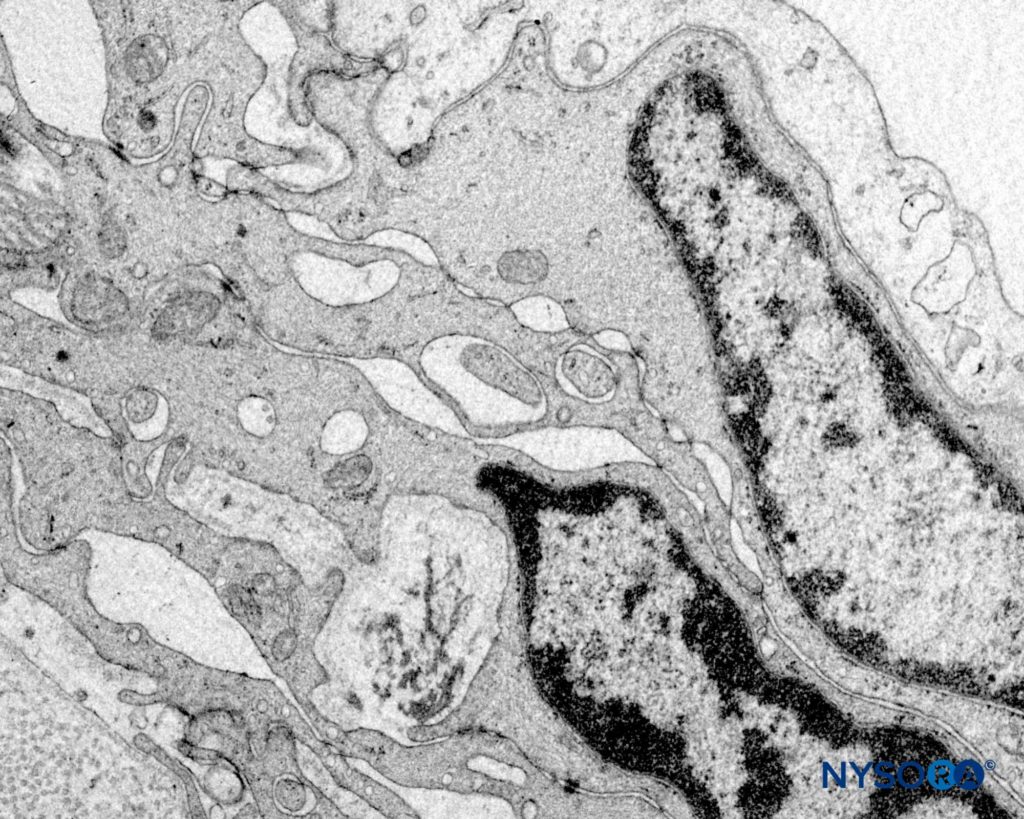 Human nerve root cuff. Detail of transition cellular barrier. Transmission electron microscopy. Magnification ×20,000. (Reproduced with permission from Reina MA, Villanueva MC, Machés F, et al: Ultrastructure of human spinal nerve root cuff in lumbar spine. Anesth Analg. 2008 Jan;106(1):339-344.)