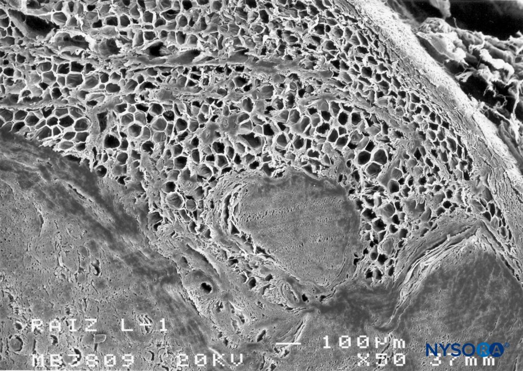 Human nerve root cuff. Detail of fat tissue in thickness of nerve root cuff. Scanning electron microscopy. Magnification ×50. (Reproduced with permission from Reina MA, Villanueva MC, López A, et al: Fat inside the dural sheath of lumbar nerve roots in humans. Rev Esp Anestesiol Reanim. 2007 May;54(5):297-301.)