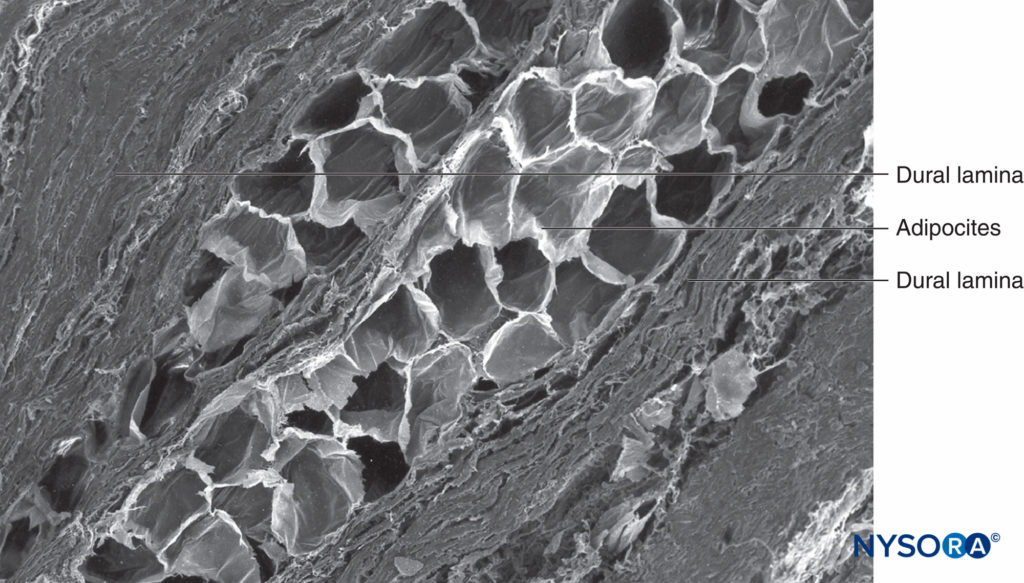 Human nerve root cuff. Detail of dural laminas in thickness of nerve root cuff. Scanning electron microscopy. Magnification ×150. (Reproduced with permission from Reina MA, Villanueva MC, Machés F, et al: Ultrastructure of human spinal nerve root cuff in lumbar spine. Anesth Analg. 2008 Jan;106(1):339-344.)