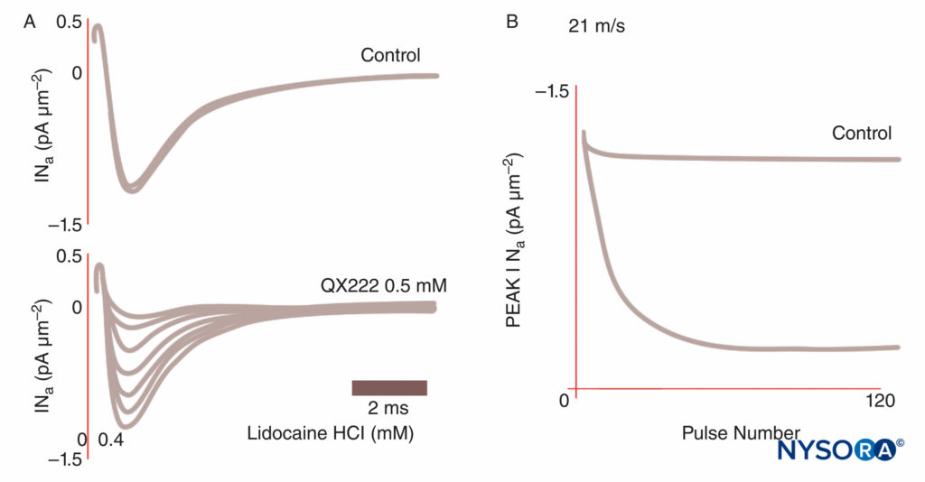 <strong>FIGURE 8.</strong> Use-dependent block of Na currents in Purkinje fibers. Under control conditions, each of a train of impulses results in identical current tracings. In the presence of the local anesthetic QX222, the first impulse is nearly the same size amplitude as under control conditions. Each succeeding impulse is smaller (reduced peak INa), reflecting an accumulating block of Na channels, until a nadir is reached. (Reproduced with permission from Hanck DA, Makielski JC, Sheets MF: Kinetic effects of quaternary lidocaine block of cardiac sodium channels: a gating current study. J Gen Physiol. 1994 Jan;103(1):19-43.)