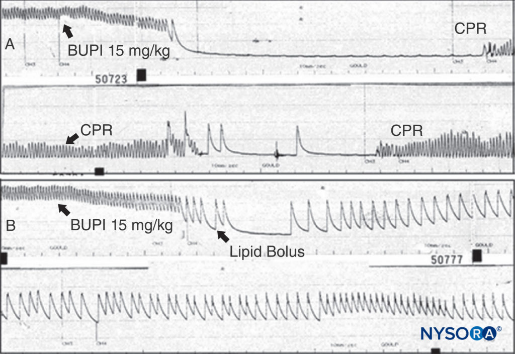 A: An anesthetized rat is given bupivacaine 15 mg/kg as indicated. The arterial blood pressure rapidly declines to cardiac arrest. Cardiopulmonary resuscitation (CPR) is given, but no arterial pressure is observed when CPR is discontinued. B: The same experiment is conducted, but a bolus of lipid is given; note that the arterial pressure is never lost (despite the same dose of bupivacaine being used), and that cardiac arrest does not ensue. (Reproduced with permission from Weinberg G: Current concepts in resuscitation of patients with local anesthetic cardiac toxicity. Reg Anesth Pain Med. 2002 Nov-Dec;27(6):568-575.)