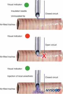 Change in peripheral nerve stimulator light and tone signal on entry of uninsulated needle tip into tracheal lumen during airway topicalization (top and middle). With injection of local anesthetic, electrical current is closed, causing another light/tone signal change (bottom).