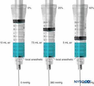 Compressed air injection technique (CAIT) to prevent high injection pressure; 50% compression of air volume in the syringe corresponds to an injection pressure of 760 mm Hg.