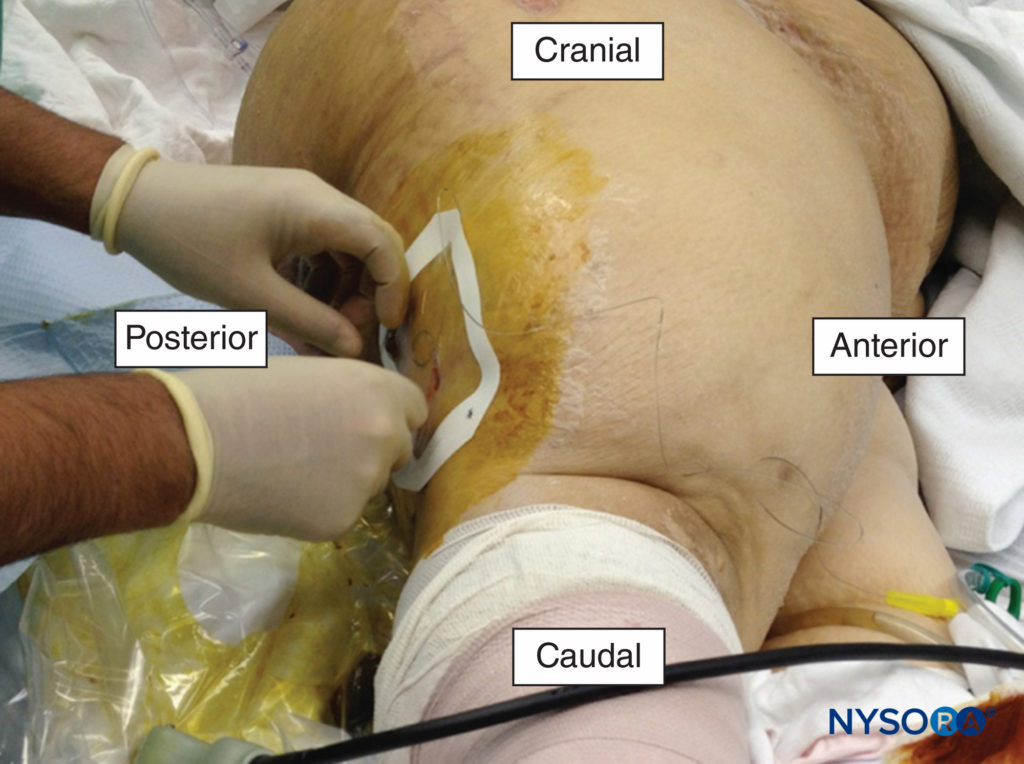 A popliteal catheter being placed for the management of pain following a traumatic amputation of the foot.