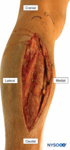 Fasciotomy of the anterior and lateral compartments of the leg to relieve acute compartment syndrome following a tibial fracture.