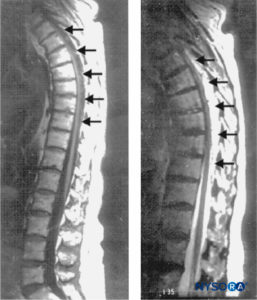 Imágenes sagitales de resonancia magnética de la columna toracolumbar. Se observa un gran hematoma epidural complejo que se extiende de T3 a T10 a través de T11 con características de señal hipodensa e isodensa en una imagen ponderada en T1 (izquierda; flechas) y características de señal hiperintensa en una imagen ponderada en T2 (derecha; flechas). En el centro del hematoma, la médula espinal se apoya en la cara posterior de la vértebra torácica. cuerpos (izquierda). No se observan anomalías de la señal del propio cordón. (Reproducido con permiso de Schwarz SK, Wong CL, McDonald WN: recuperación espontánea de un hematoma epidural espinal con presentación atípica en un nonagenario. Can J Anaesth. 2004 junio-julio;51(6):557–561.)
