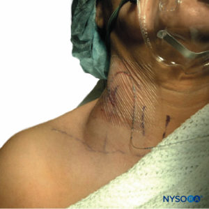 Hematoma cervical en un paciente al que se le puncionó la vena yugular externa con una aguja estilo Tuohy calibre 18 durante la inserción de un catéter en el surco interescalénico. El hematoma mostrado era autónomo y se trató de forma conservadora con compresión local.