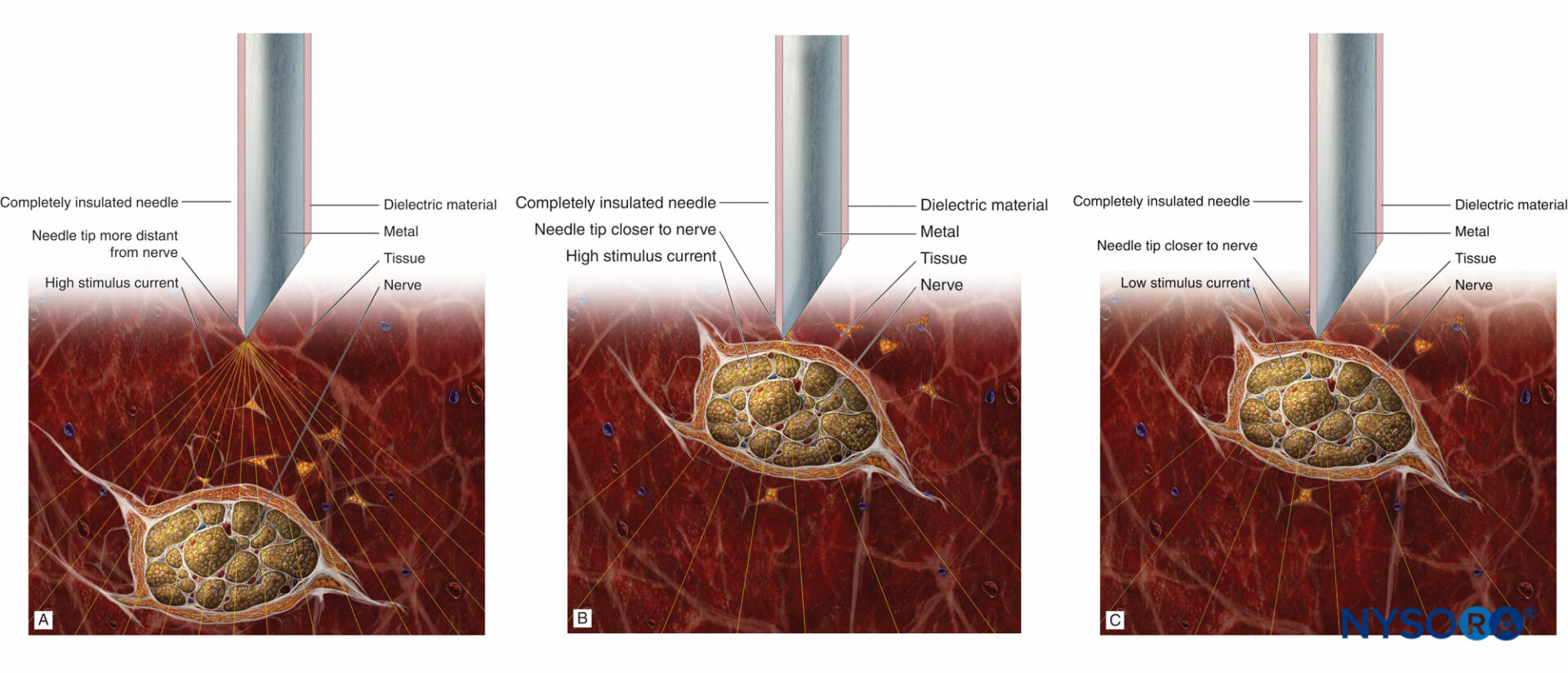 Transcutaneous electrical nerve stimulation - Wikipedia