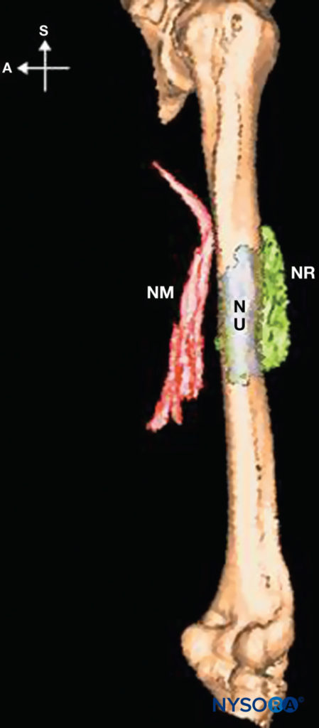 Distribution of injectates after midhumeral blockade. NM = nervus medialis, NU = nervus ulnaris, NR = nervus radialis.