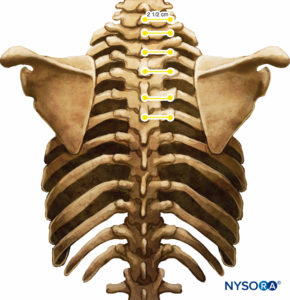 Relationship between spinous and transverse processes.
