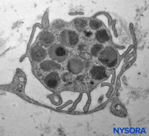 Mastocyte inside fascicles from tibial nerve. Transmission electron microscopy. Magnification ×7000. (Reproduced with permission from Reina MA: Atlas of Functional Anatomy for Regional Anesthesia and Pain Medicine. New York: Springer; 2015.)