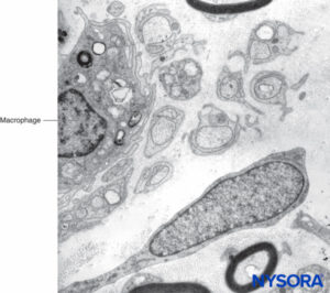 Macrophage within fascicles as seen on Transmission electron microscopy. Magnification ×7000.