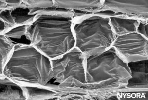 Adipocytes in interfascicular tissue of sciatic nerve. Scanning electron microscopy. Magnification ×400. (Reproduced with permission from Reina MA, López A, De Andrés JA: Adipose tissue within peripheral nerves. Study of the human sciatic nerve. Rev Esp Anestesiol Reanim. 2002 Oct;49(8):397-402.)