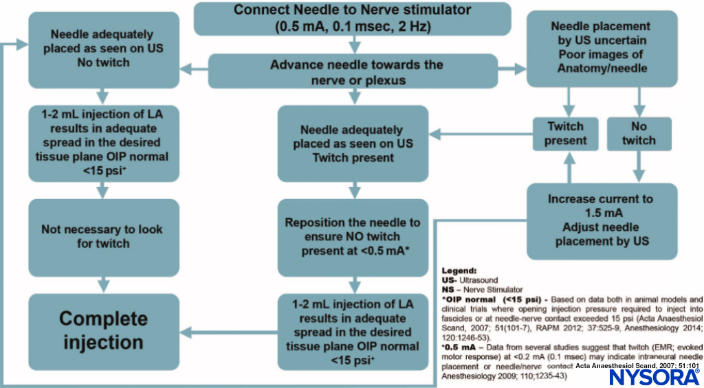 An algorithm for use of nerve stimulation with ultrasound-guided nerve blocks. Please note that the nerve stimulator here is used primarily as a safety-monitoring tool, rather than a nerve localization tool. The stimulator is set at 0.5 mA (0.1 ms), and the current is rarely manipulated. Instead, a motor response is obtained; extra caution is exercised as this indicates an intimate needle-nerve relationship. Instead of adjusting the current intensity to determine at which current the motor response extinguishes, the needle is slightly withdrawn to abolish the response and distance the needle tip from the nerve. A small amount of local anesthetic is then injected to determine the needle tip location while avoiding an opening pressure greater than 15 psi. LA, local anesthetic; OIP, opening injection pressure.