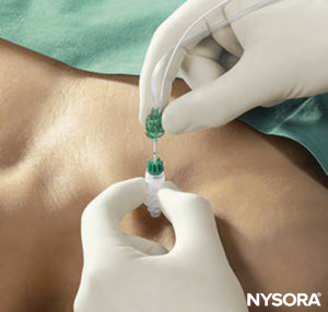 Percutaneous electrode guidance technique using Stimuplex Guide (B. Braun, Melsungen, Germany) during a vertical infraclavicular block procedure.