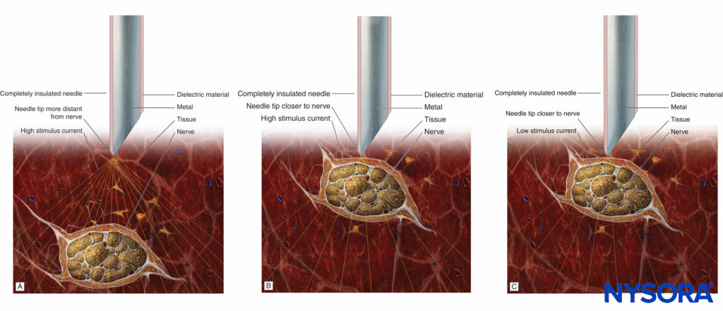A: Stimulation needle at a distance to the nerve and high stimulus current eliciting a weak motor response. B: Stimulation needle close to the nerve and high stimulus current eliciting a strong motor response. C: Stimulation needle close to the nerve and low (near-threshold) stimulus current eliciting a weak motor response.