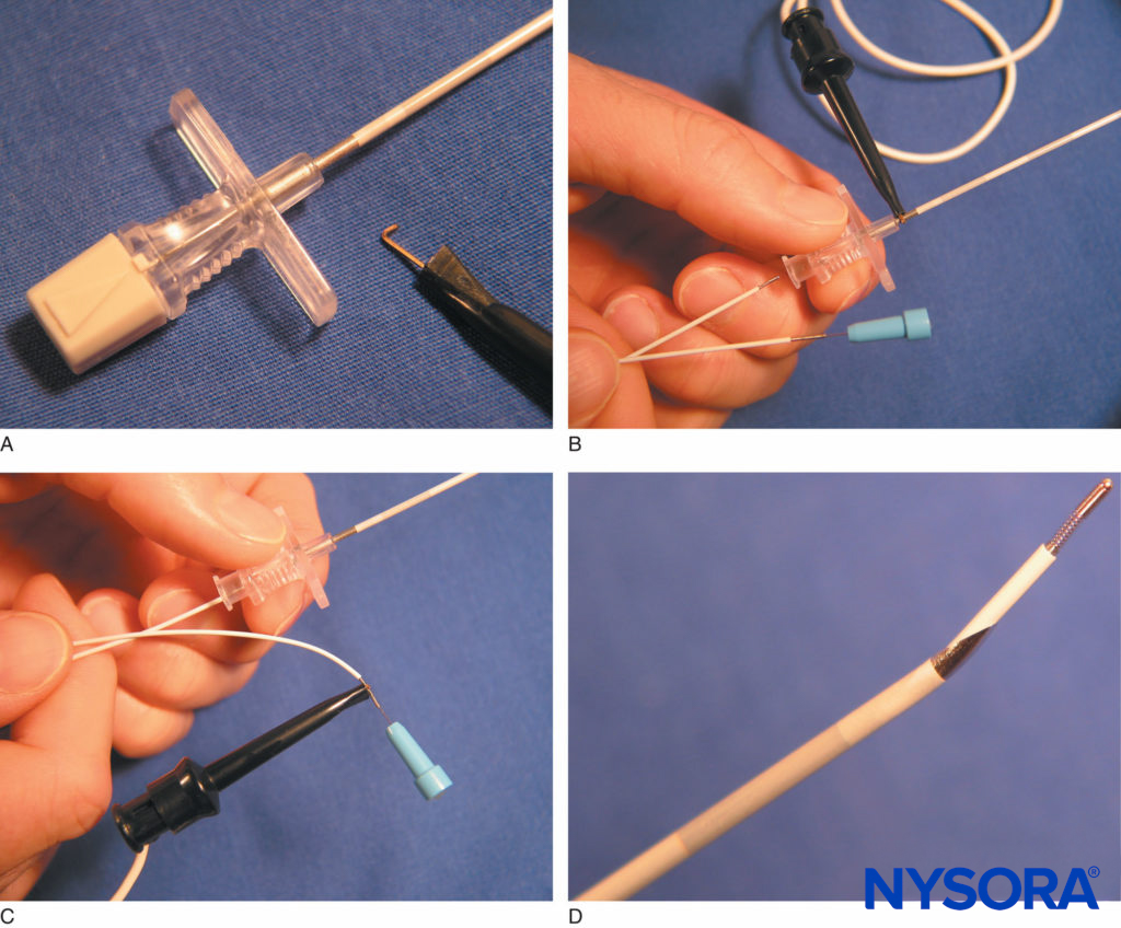 A: An alligator clip connects to an uninsulated segment on the proximal needle shaft of the StimuCath® system (Arrow International, Reading, PA). B: The StimuCath system consists of an insulated Tuohy tip needle, a stimulating catheter, and an alligator clip connector. C: The alligator clip is removed from the needle and attached to the catheter’s proximal end. This provides current output to the catheter’s distal tip. D: The Tuohy needle tip with a 5-mm long uninsulated segment is seen with the distal tip of the StimuCath stimulating catheter. (Used with permission from Holly Evans, MD.)